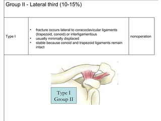 Group II - Lateral third (10-15%) Type I <ul><li>fracture occurs lateral to coracoclavicular ligaments (trapezoid, conoid)...