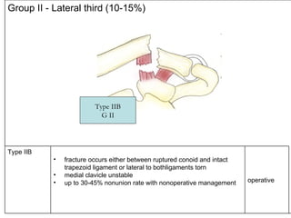 Group II - Lateral third (10-15%) Type IIB <ul><li>fracture occurs either between ruptured conoid and intact trapezoid lig...