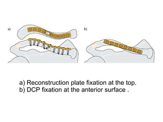 a) Reconstruction plate fixation at the top. b) DCP fixation at the anterior surface .  