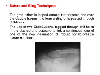 <ul><li>Suture and Sling Techniques </li></ul><ul><li>The graft either is looped around the coracoid and over the clavicle...