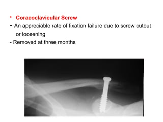 <ul><li>Coracoclavicular Screw   </li></ul><ul><li>-  An appreciable rate of fixation failure due to screw cutout or loose...