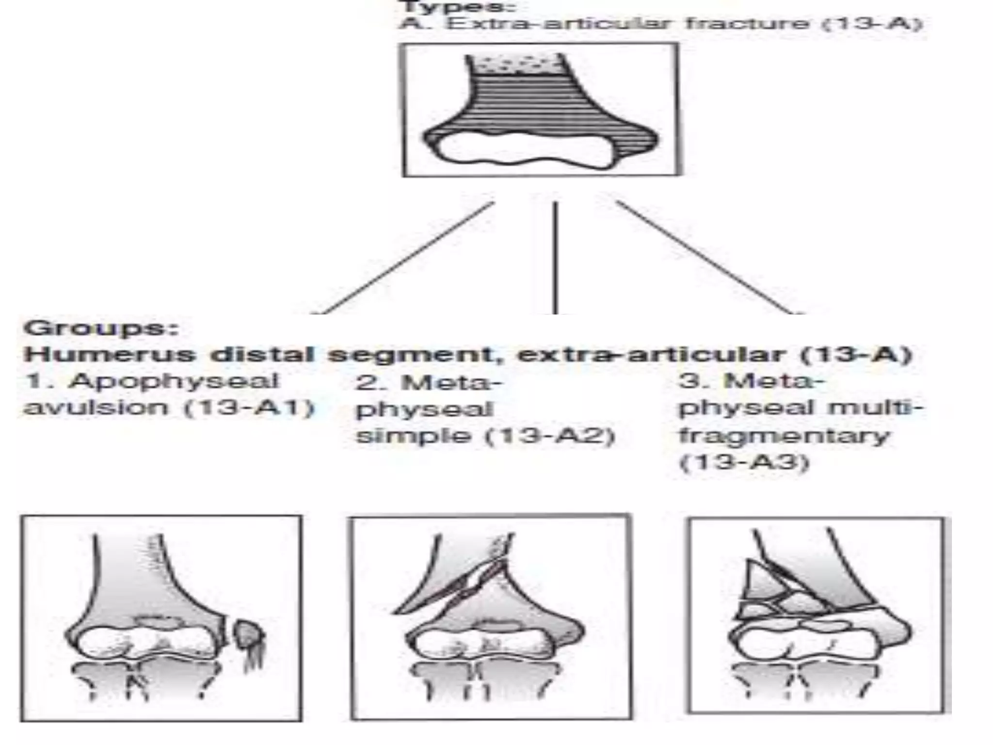 Tfdh Fractures of the distal humerus ppt | PPTX