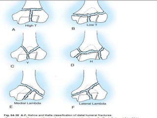 Tfdh Fractures of the distal humerus ppt | PPTX