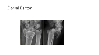 Fractures of the distal radial physis and barton's fracture | PPTX