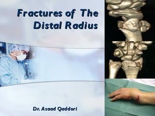 Fr actures of The
    Distal R adius




   Dr. A saad Qaddor i
 