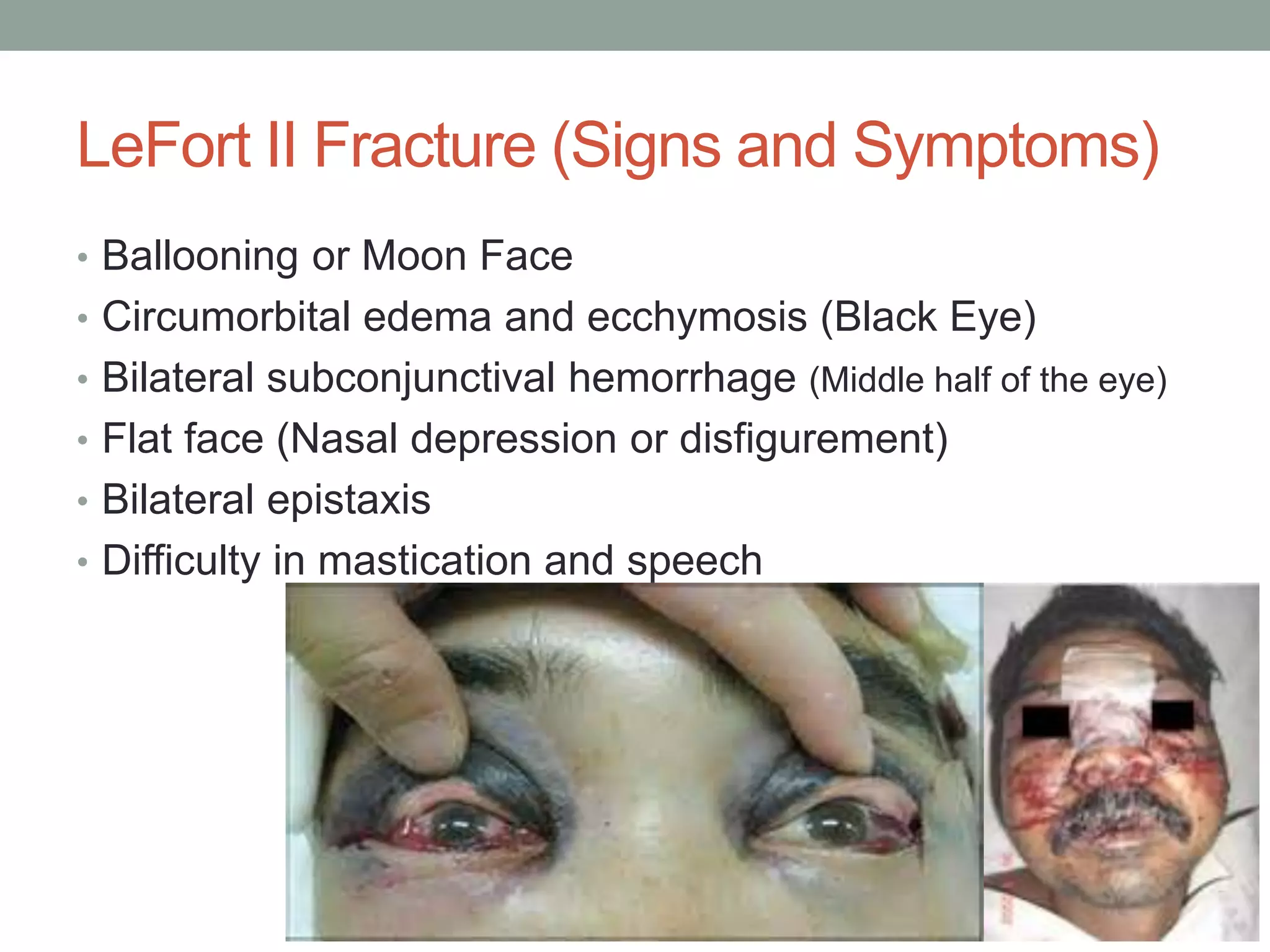 Lefort Injuries Fractures of the Middle third of the Facial Skeleton | PPTX