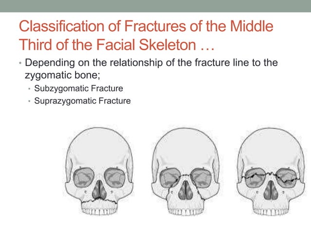 Fractures of the Middle third of the Facial Skeleton | PPTX
