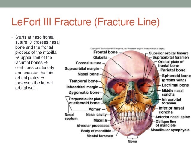 lefort fracture