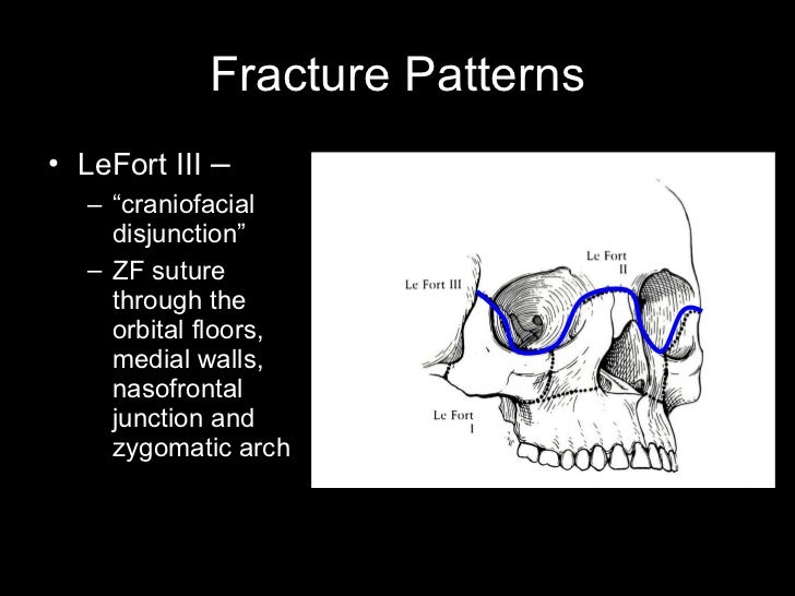 Fractures of the Midface / Orbit