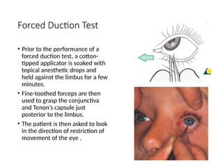 fractures of the orbit and mid face skeleton | PPTX