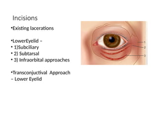 Subciliary Approach Incision fractures of the orbit and mid face skeleton | PPTX