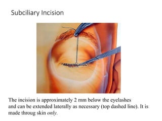 Subciliary Approach Incision fractures of the orbit and mid face skeleton | PPTX