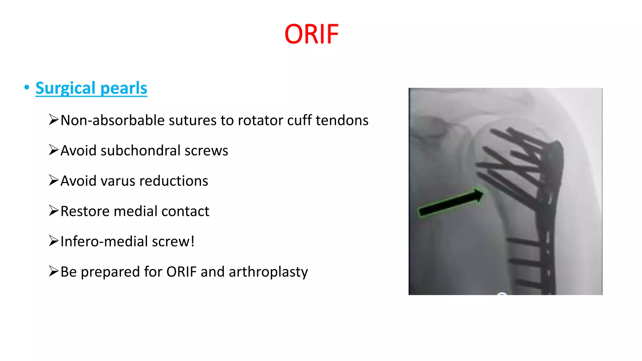 Fractures of the proximal humerus | PPTX