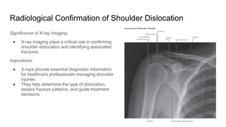 Radiological Confirmation of Shoulder Dislocation
Significance of X-ray Imaging:
● X-ray imaging plays a critical role in confirming
shoulder dislocation and identifying associated
fractures.
Importance:
● X-rays provide essential diagnostic information
for healthcare professionals managing shoulder
injuries.
● They help determine the type of dislocation,
assess fracture patterns, and guide treatment
decisions.
 