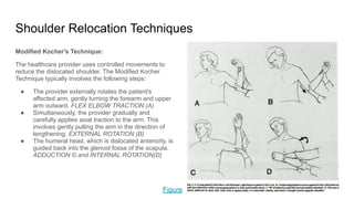 Shoulder Relocation Techniques
Modified Kocher's Technique:
The healthcare provider uses controlled movements to
reduce the dislocated shoulder. The Modified Kocher
Technique typically involves the following steps:
● The provider externally rotates the patient's
affected arm, gently turning the forearm and upper
arm outward. FLEX ELBOW TRACTION (A)
● Simultaneously, the provider gradually and
carefully applies axial traction to the arm. This
involves gently pulling the arm in the direction of
lengthening. EXTERNAL ROTATION (B)
● The humeral head, which is dislocated anteriorly, is
guided back into the glenoid fossa of the scapula.
ADDUCTION © and INTERNAL ROTATION(D)
Figure
 
