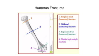 Humerus Fractures
 