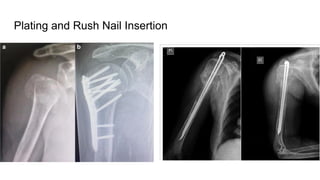 Plating and Rush Nail Insertion
 