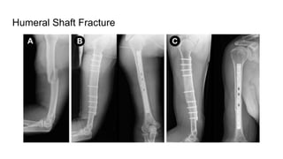 Humeral Shaft Fracture
 