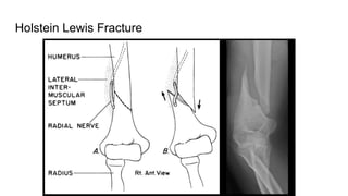 Holstein Lewis Fracture
 