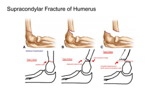 Supracondylar Fracture of Humerus
 