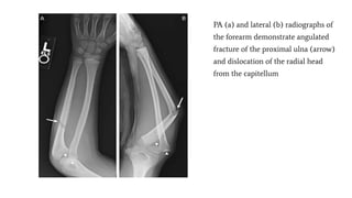 PA (a) and lateral (b) radiographs of
the forearm demonstrate angulated
fracture of the proximal ulna (arrow)
and dislocation of the radial head
from the capitellum
 