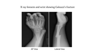 X ray forearm and wrist showing Galeazzi’s fracture
AP View Lateral View
 