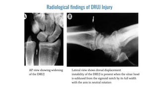 Radiological ﬁndings of DRUJ Injury
AP view showing widening
of the DRUJ
Lateral view shows dorsal displacement
instability of the DRUJ is present when the ulnar head
is subluxed from the sigmoid notch by its full width
with the arm in neutral rotation
 