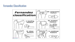 Fernandez Classiﬁcation
 