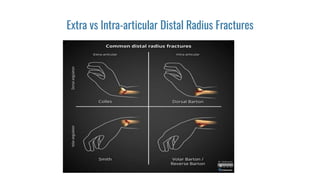 Extra vs Intra-articular Distal Radius Fractures
 