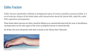 Colles Fracture
Colles’ fracture speciﬁcally is deﬁned as metaphyseal injury of cortico-cancellous junction (within 2−3
cm of articular surface) of the distal radius with characteristic dorsal tilt, dorsal shift, radial tilt, radial
shift, supination and impaction.
These distal radius fractures are often caused by falling on an outstretched hand with the wrist in dorsiﬂexion,
causing tension on the volar aspect of the wrist, causing the fracture to extend dorsally.
On X-Ray, the wrist will present with what is known as the “dinner-fork” deformity.
 