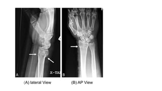 (A) lateral View (B) AP View
 