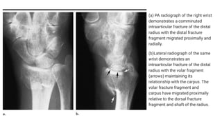 (a) PA radiograph of the right wrist
demonstrates a comminuted
intraarticular fracture of the distal
radius with the distal fracture
fragment migrated proximally and
radially.
(b)Lateral radiograph of the same
wrist demonstrates an
intraarticular fracture of the distal
radius with the volar fragment
(arrows) maintaining its
relationship with the carpus. The
volar fracture fragment and
carpus have migrated proximally
relative to the dorsal fracture
fragment and shaft of the radius.
 