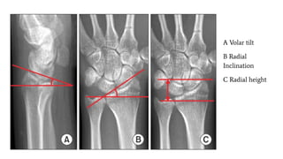 A Volar tilt
B Radial
Inclination
C Radial height
 