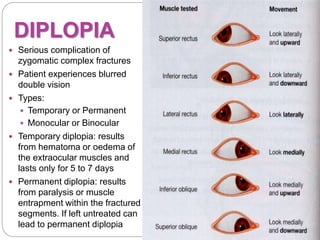 Diplopia Types FRACTURES OF THE ZYGOMATIC COMPLEX AND ORBIT.pptx.pptx