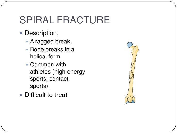 treatment of a spiral fracture treatment of a spiral fracture
