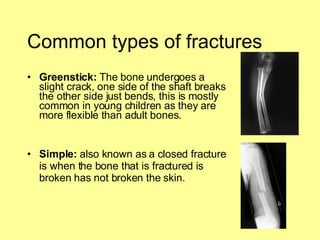 Common types of fractures Greenstick:  The bone undergoes a slight crack, one side of the shaft breaks the other side just bends, this is mostly common in young children as they are more flexible than adult bones. Simple:  also known as a closed fracture is when the bone that is fractured is broken has not broken the skin. 
