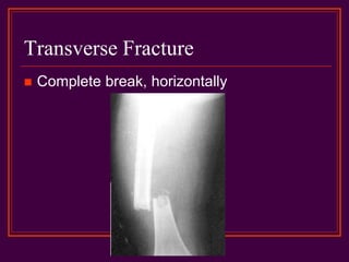 Transverse Fracture
 Complete break, horizontally
 