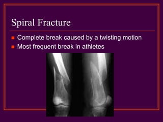 Spiral Fracture
 Complete break caused by a twisting motion
 Most frequent break in athletes
 