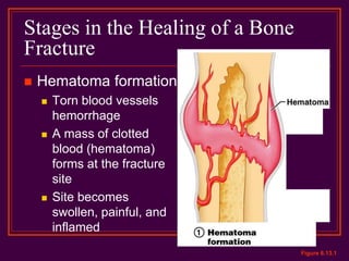 Stages in the Healing of a Bone
Fracture
 Hematoma formation
 Torn blood vessels
hemorrhage
 A mass of clotted
blood (hematoma)
forms at the fracture
site
 Site becomes
swollen, painful, and
inflamed
Figure 6.13.1
 