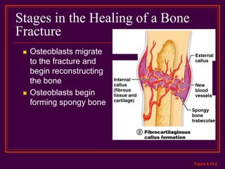 Stages in the Healing of a Bone
Fracture
 Osteoblasts migrate
to the fracture and
begin reconstructing
the bone
 Osteoblasts begin
forming spongy bone
Figure 6.13.2
 