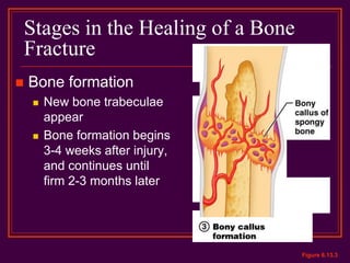 Stages in the Healing of a Bone
Fracture
 Bone formation
 New bone trabeculae
appear
 Bone formation begins
3-4 weeks after injury,
and continues until
firm 2-3 months later
Figure 6.13.3
 