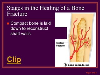 Stages in the Healing of a Bone
Fracture
 Compact bone is laid
down to reconstruct
shaft walls
Figure 6.13.4
 