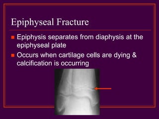 Epiphyseal Fracture
 Epiphysis separates from diaphysis at the
epiphyseal plate
 Occurs when cartilage cells are dying &
calcification is occurring
 