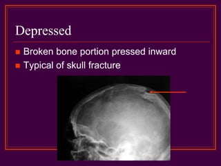 Depressed
 Broken bone portion pressed inward
 Typical of skull fracture
 