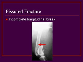 Fissured Fracture
 Incomplete longitudinal break
 