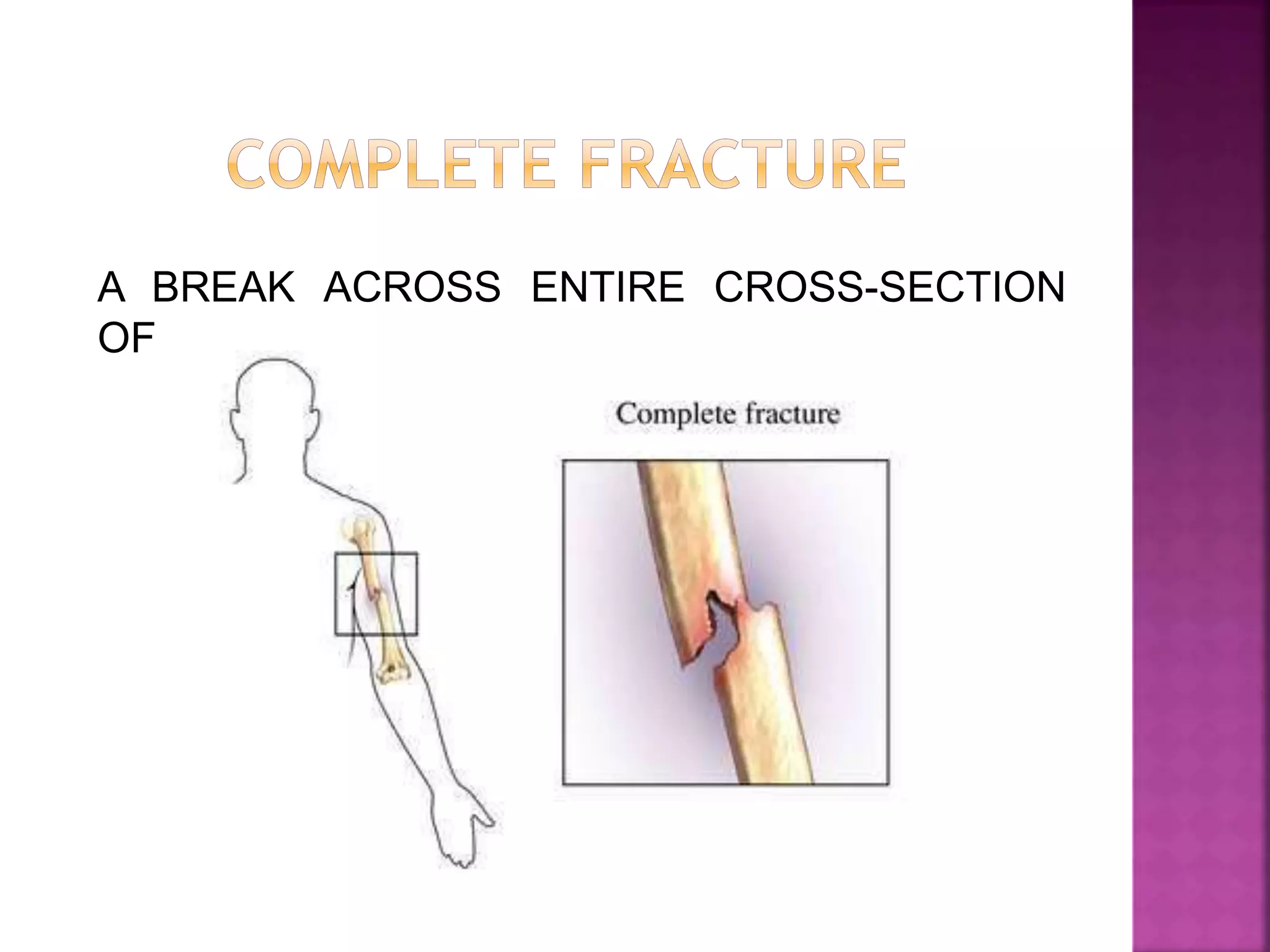 Fractures and types | PPTX