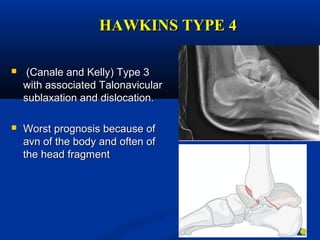 HAWKINS TYPE 4HAWKINS TYPE 4
 (Canale and Kelly) Type 3(Canale and Kelly) Type 3
with associated Talonavicularwith associated Talonavicular
sublaxation and dislocation.sublaxation and dislocation.
 Worst prognosis because ofWorst prognosis because of
avn of the body and often ofavn of the body and often of
the head fragmentthe head fragment
 