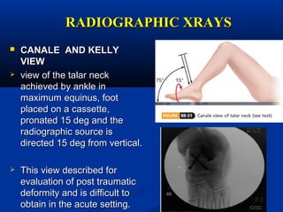 RADIOGRAPHIC XRAYSRADIOGRAPHIC XRAYS
 CANALE AND KELLYCANALE AND KELLY
VIEWVIEW
 view of the talar neckview of the talar neck
achieved by ankle inachieved by ankle in
maximum equinus, footmaximum equinus, foot
placed on a cassette,placed on a cassette,
pronated 15 deg and thepronated 15 deg and the
radiographic source isradiographic source is
directed 15 deg from vertical.directed 15 deg from vertical.
 This view described forThis view described for
evaluation of post traumaticevaluation of post traumatic
deformity and is difficult todeformity and is difficult to
obtain in the acute setting.obtain in the acute setting.
 
