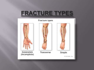FRACTURE TYPES 