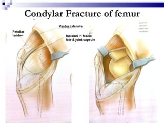 Fracture types & managemental approach | PPT